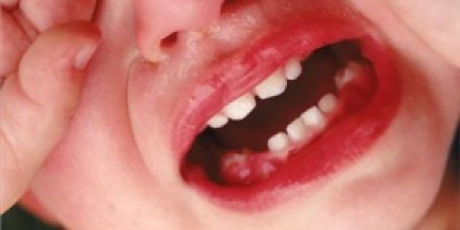 kids tooth 1 مراقبت دندان کودک